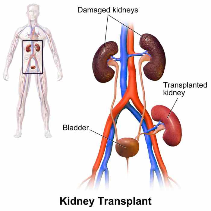 Kidney_Transplant.jpg